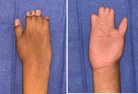 poland syndrome hand surgery